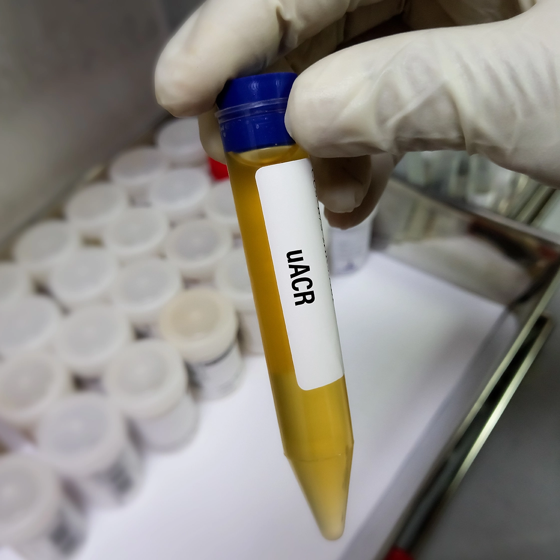 Elevated UACR even Below Normal Range Increases the Newonset HF Risk in T2DM Patients