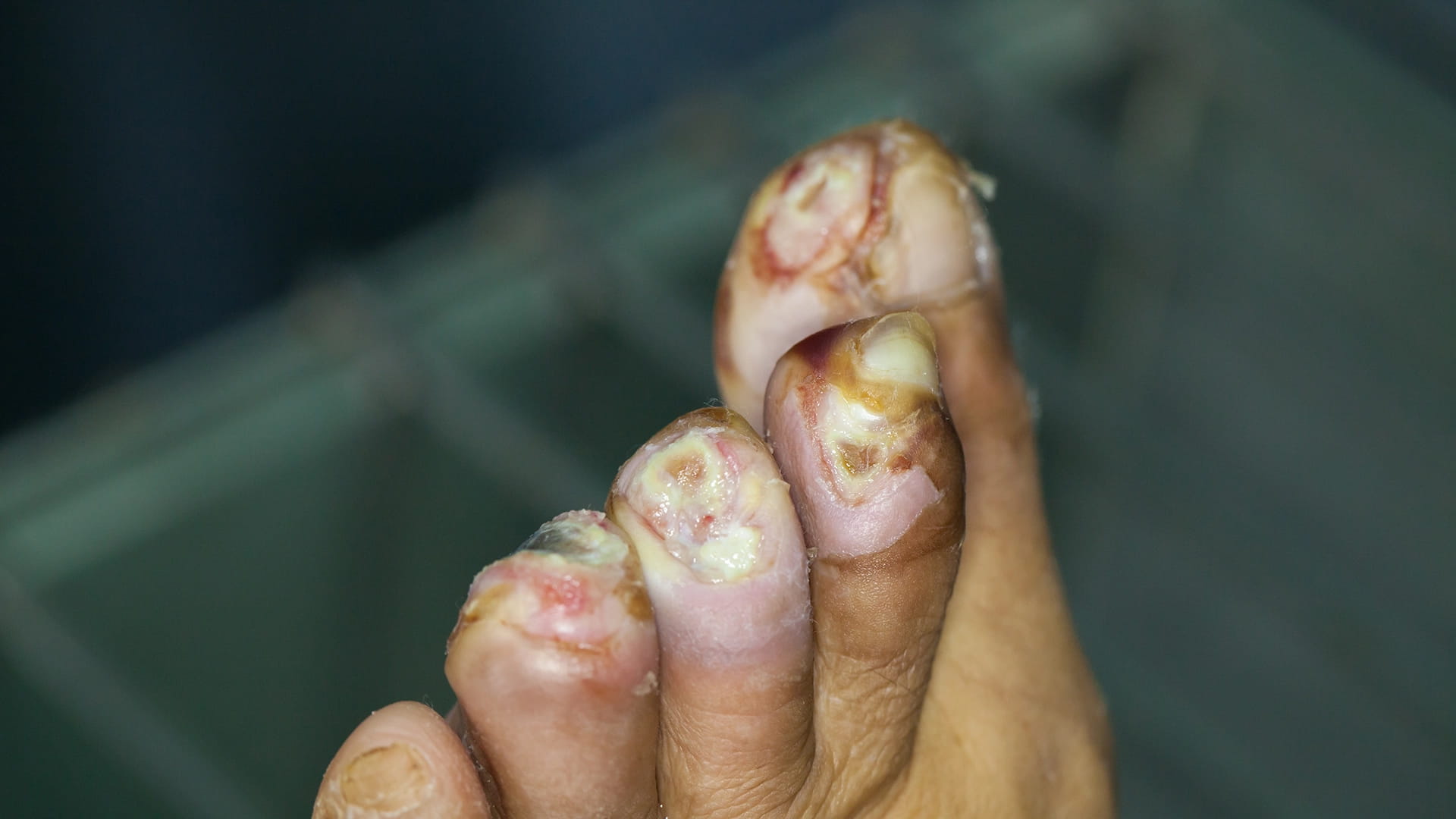 Utility of MRSA Nasal PCR Testing on Antibiotic Use and Clinical Outcomes in Diabetic Foot Infection