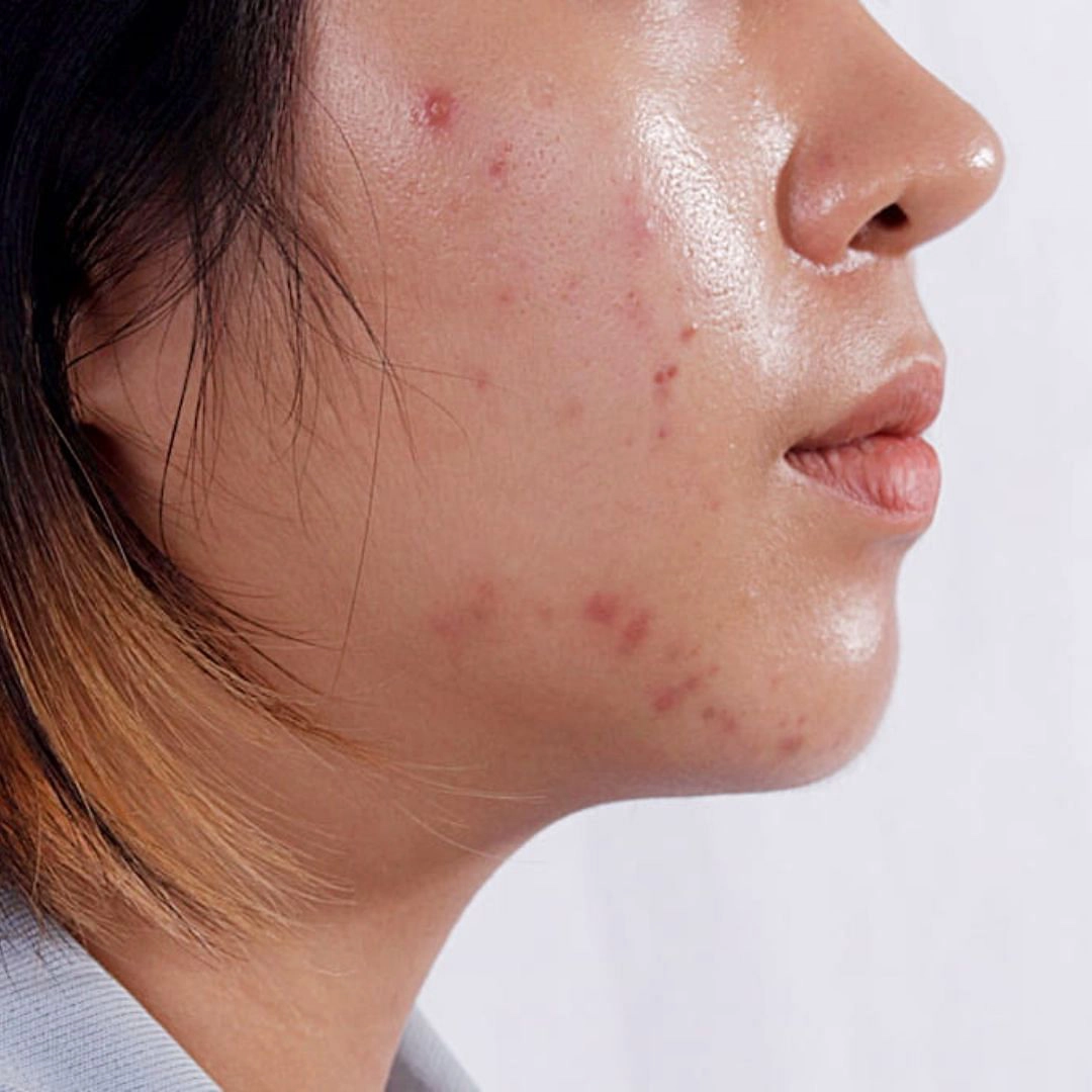 Acne